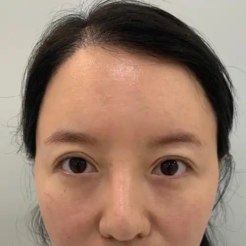 上眼睑下垂的严重,特别是这两年,见人都说我老的快,_圈子-新氧美容整