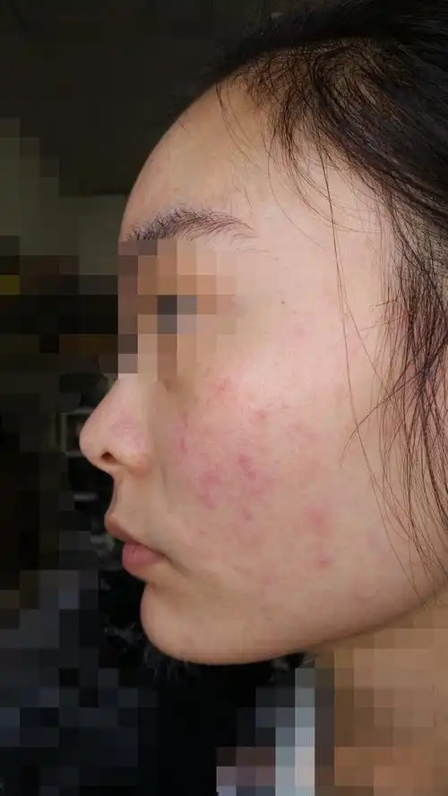 过敏性皮肤该怎么办