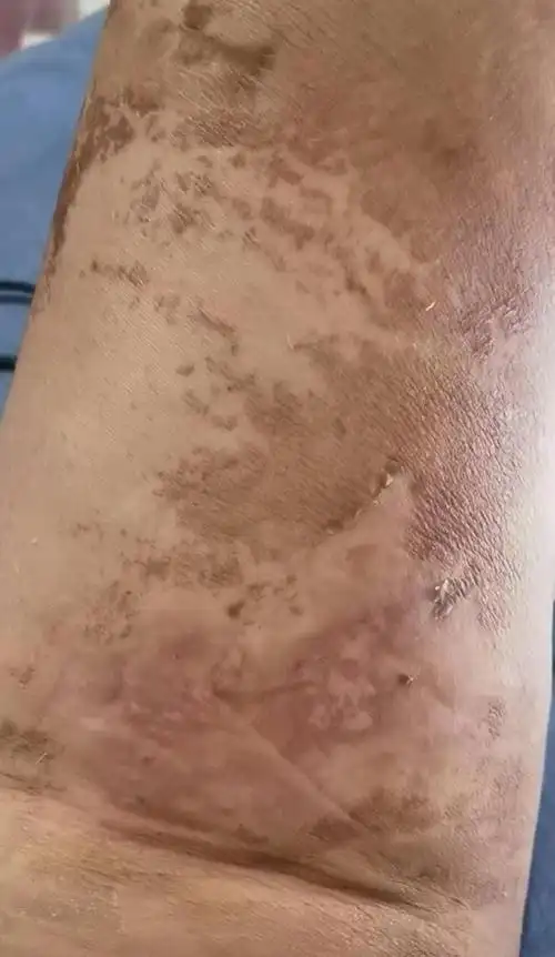 我这个是不是大腿吸脂失败了