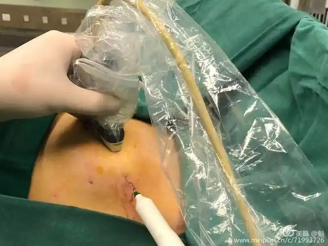 消融针穿刺入肿瘤组织消融范围完整覆盖病灶术后皮肤无切口术后第一天