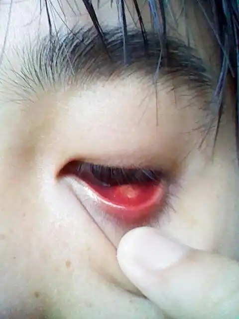 是不是麦粒肿?能不能用针扎破?三天了