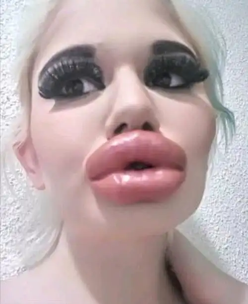 22岁少女丰唇20次,嘴唇肿的跟香肠一样,吃饭都困难,仍要继续