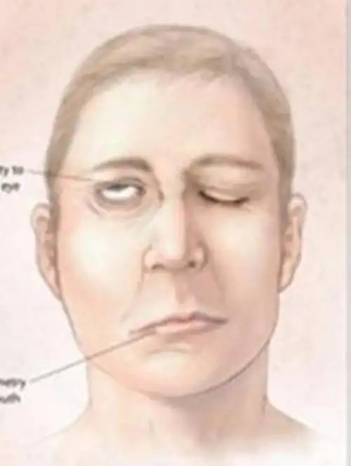 夜间人处于放松状态,抵抗力下降,长时间湿发容易刺激耳后的面神经