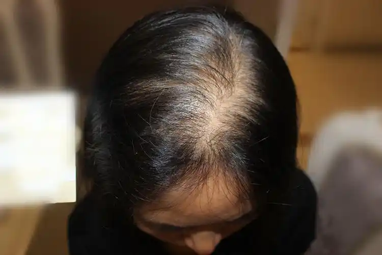 女生脱发可以吃螺内酯吗