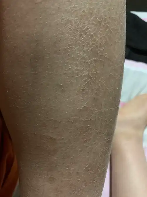 我的鱼鳞腿怎么救啊01