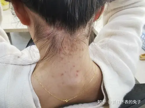 求助脖子后面疯狂长痘痘是为什么