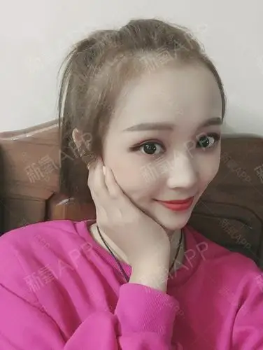 双眼皮后,别人对我的印象再也不是单眼皮小眼睛了_圈子-新氧美容整形