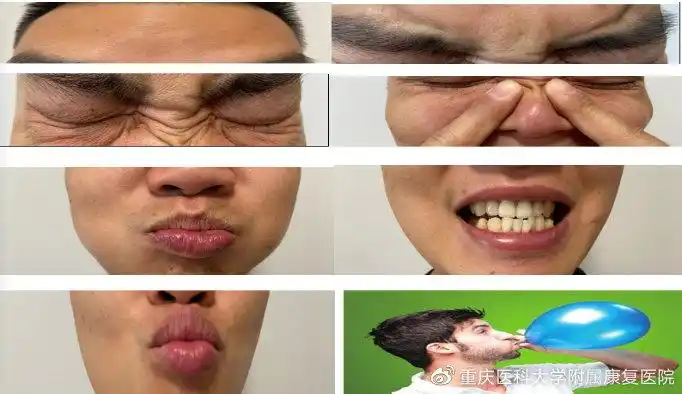 面瘫居家康复