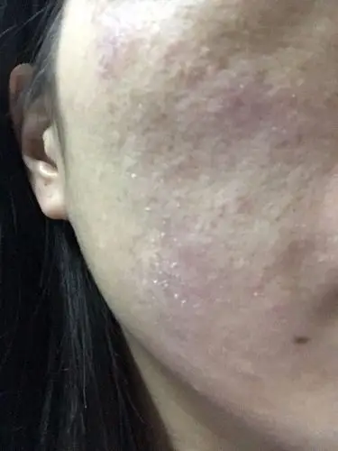 脸上红红的,又很痒,摸起脸部来很粗糙,干燥并且带有脱皮现象.