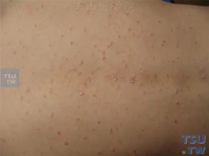 寻常型银屑病(psoriasis vulgaris)的症状表现