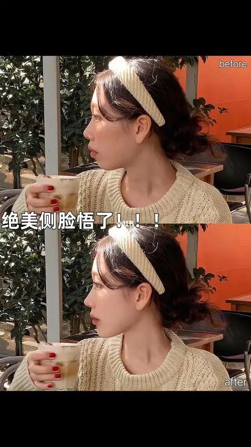 侧脸不好看嘴凸没有下颌线的姐妹进绝01