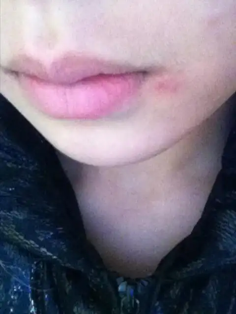 回答: 您好,根据你的情况,考虑一般是由病毒感染引起的单纯疱疹常常在