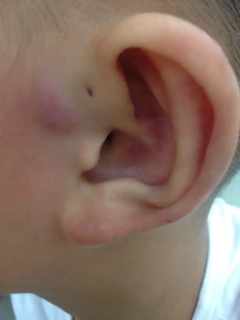 小孩耳朵边有个洞,边上肿紫严重吗?吃头孢用吗?