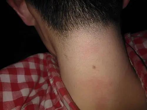 脖子上的一颗痣变粗糙有没有事?