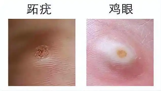 生活中常见的疣体有哪些?