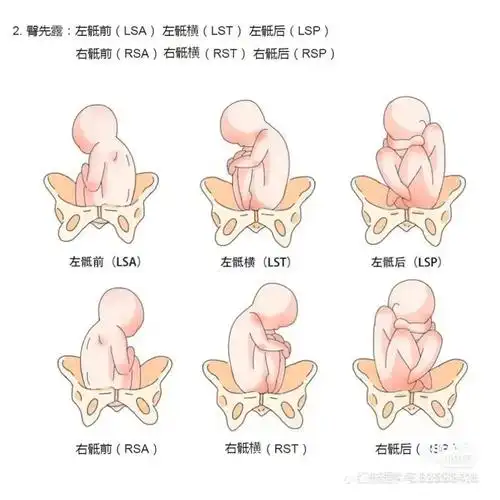 已经做好了顺产的准备,谁知道今天彩超一出来,芭比q了,rsa,整了个胎位