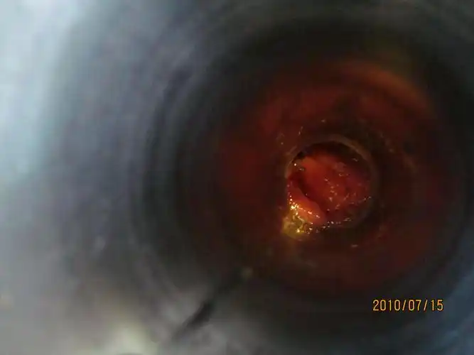 混合痔手术3年钛钉怎么没有未脱