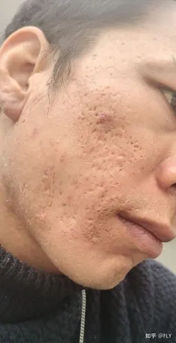 十二年痘坑现在准备试一试