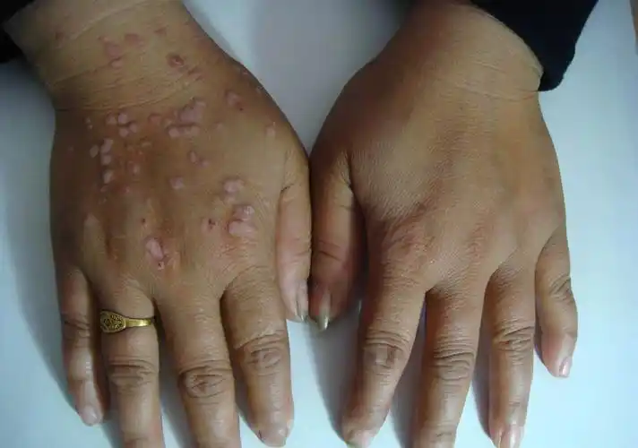 手掌扁平疣图片大全