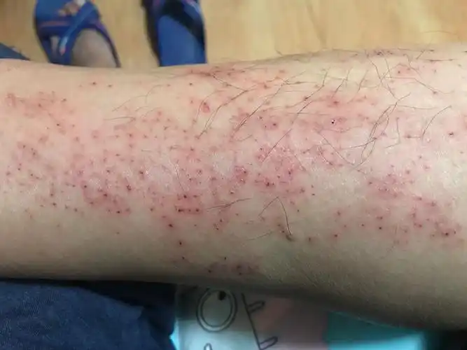 入冬前小腿很痒,抓挠出血后出现红疙瘩怎么回事? - 知乎