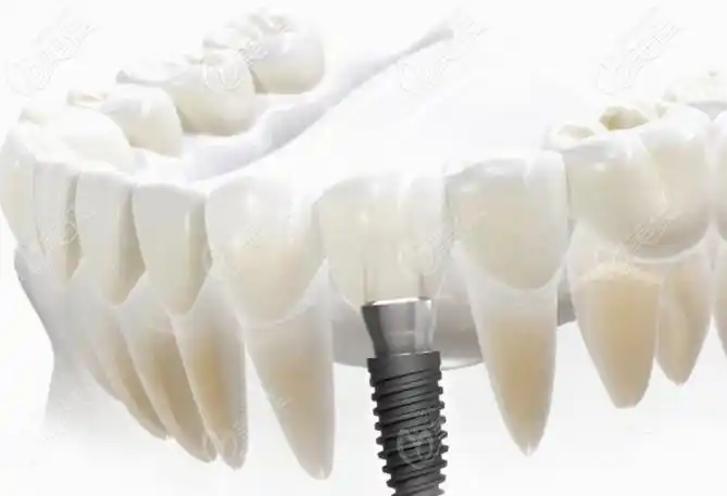 种植牙价格贵的和便宜的区别在哪里难道越贵的使用寿命越长