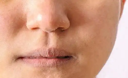 冬天皮肤特别干燥是怎么回事怎样缓解皮肤干燥