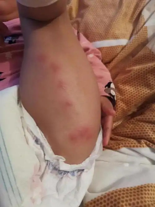 如何判断一个包是被跳蚤咬还是臭虫咬