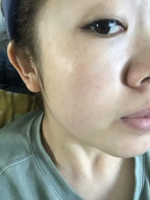 掉痂的地方呈白色,肤色不均匀