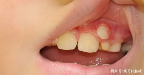 轻易拔除虎牙的危害是什么