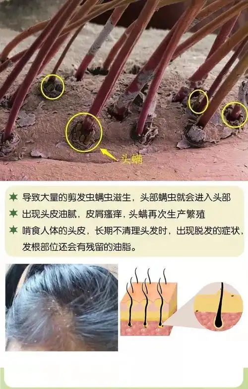 315岁中大童儿童除螨洗发水剪发虫头皮痒去屑除螨虫止痒洗发露1瓶洗发