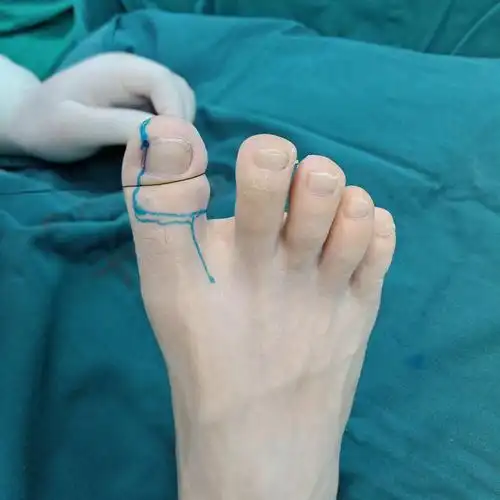 为设计人员完美再造拇指一例 - 好大夫在线