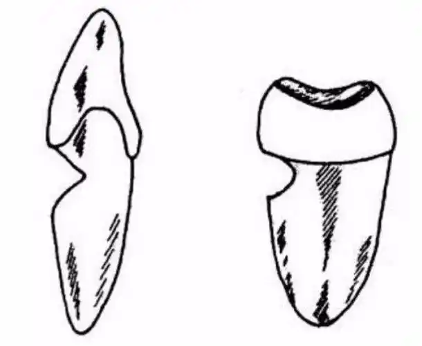 牙齿楔状缺损常常出现在前磨牙,尖牙,缺损区呈楔状,边缘整齐,表面光滑