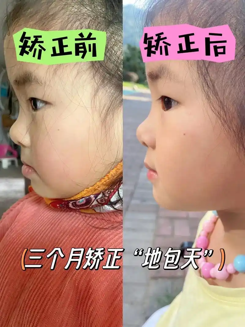 三个月矫正好"地包天"女儿从第一天戴牙套到最后摘牙套的变化, - 抖音