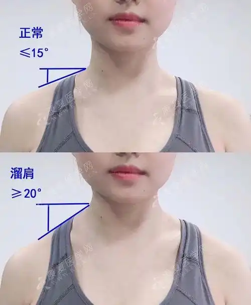 斜方肌紧张,颈后大包,上交叉综合征,造成虎背熊腰的原因都在这了!