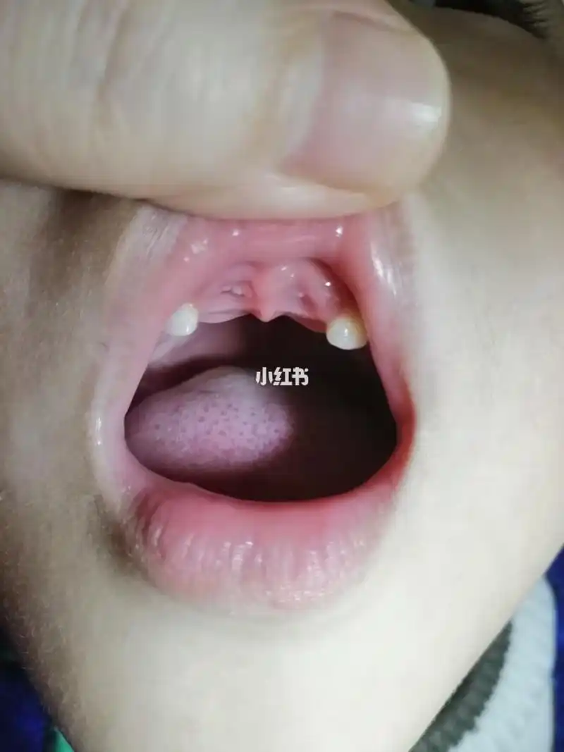 一个牙龈长了两颗牙