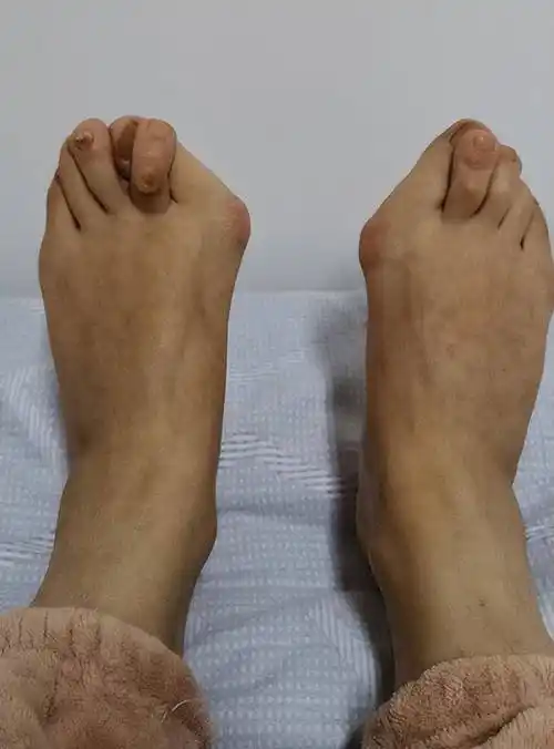 拇外翻合并叠趾畸形,和大拇趾长有很大关系,拇外翻_手术_典型_关节炎