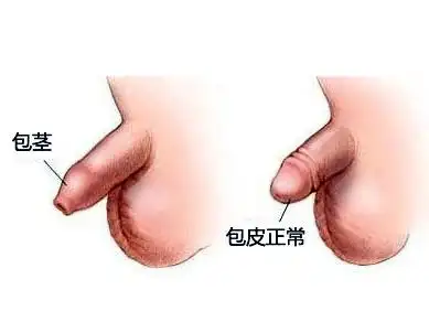 包皮包茎容易并发的疾病