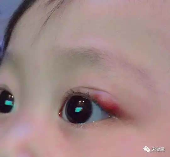 得了麦粒肿再也不求人三个方法教你快速解决