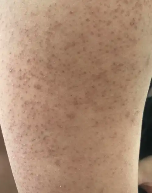 在胳膊上像这个样子后来我接触皮肤科以后,才知道这是所谓的"鸡皮肤"