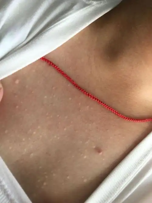 【皮肤】胸口上长这些白点点是什么.