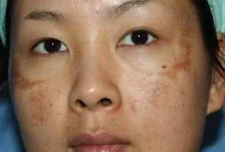 肝斑.jpg