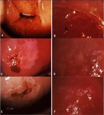 宫颈癌图片 (32)