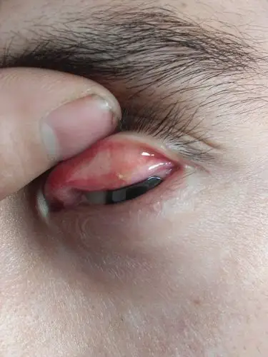 左眼睛上眼皮中间长了个白色的小疙瘩,大家看看是什么情况?