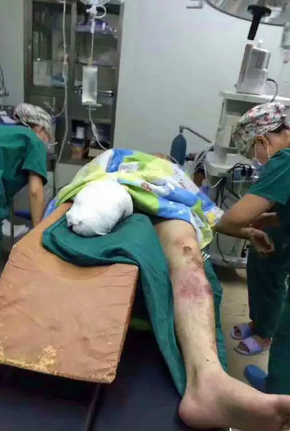 重庆一小伙跳下火车救老太失去一条腿,截肢后称不后悔(组图)