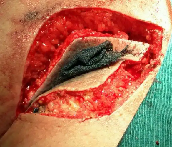 藏毛窦切除一例