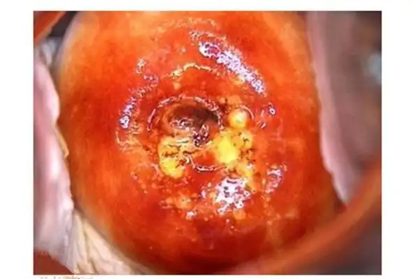 宫颈癌的早期症状图片7