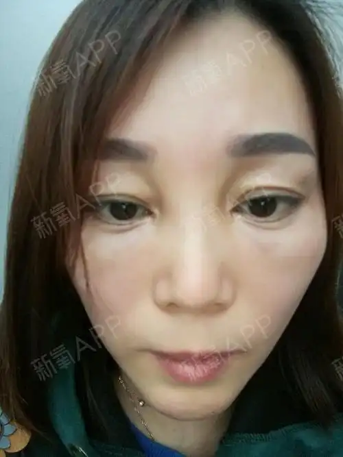 通过新氧消费方案查看自体脂肪丰泪沟手术无明显痛感违法和不良信息