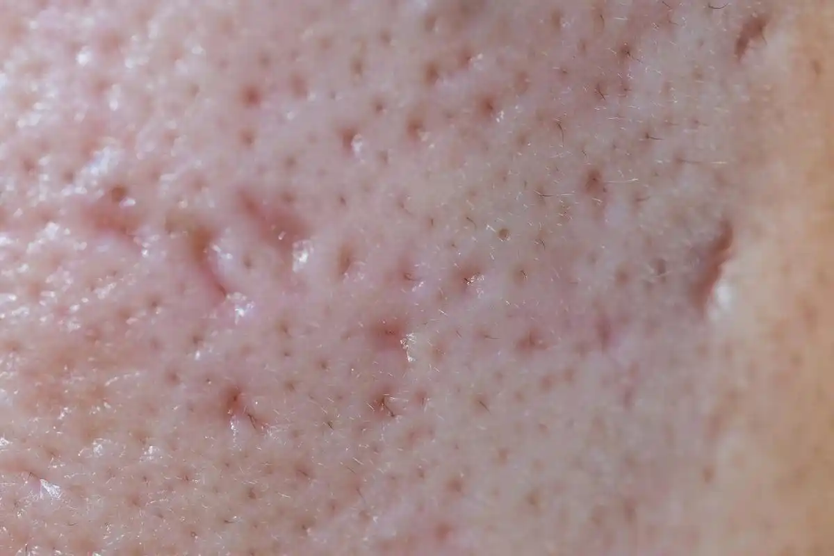 毛孔粗大的女生必看!净化毛孔,祛黑头正确法操作!