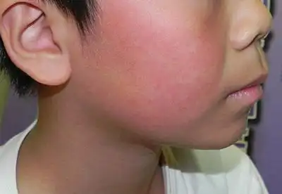 宝宝红红苹果脸 小心是得苹果病