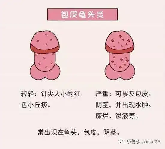 病因:包皮龟头炎是指包皮内板与阴茎头的炎症.